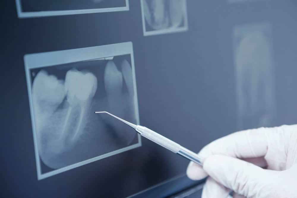 Dental x-ray